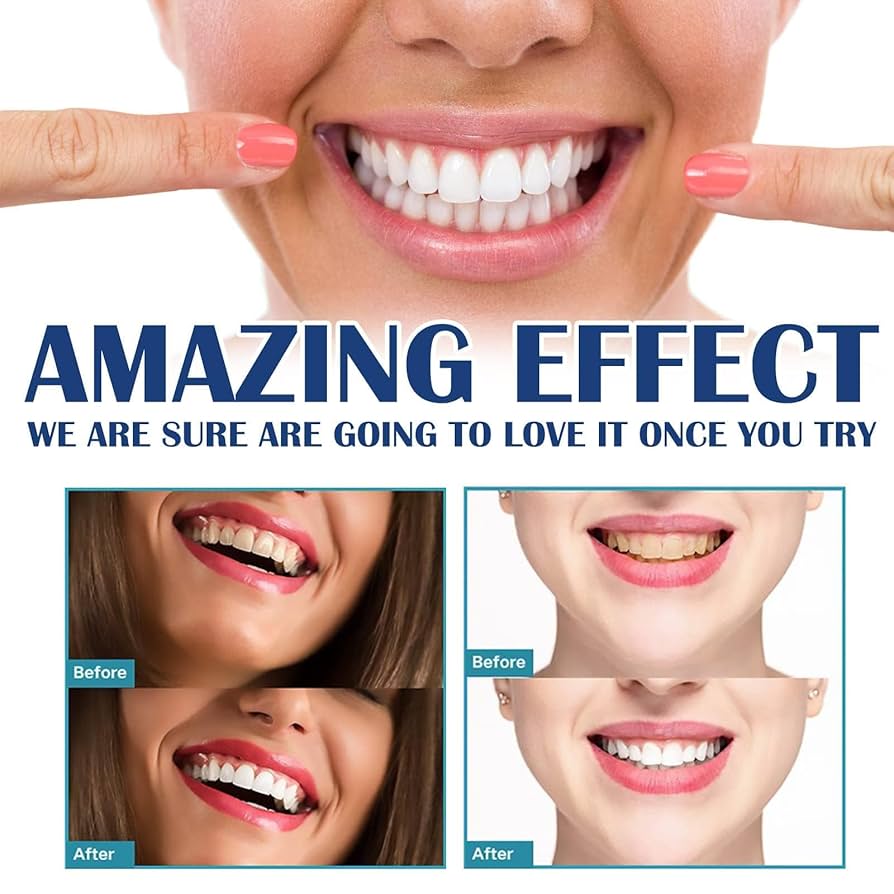 Aufkleber zur Zahnaufhellung,  – Teeth Whitening Gel Refills Bewertung und Preis