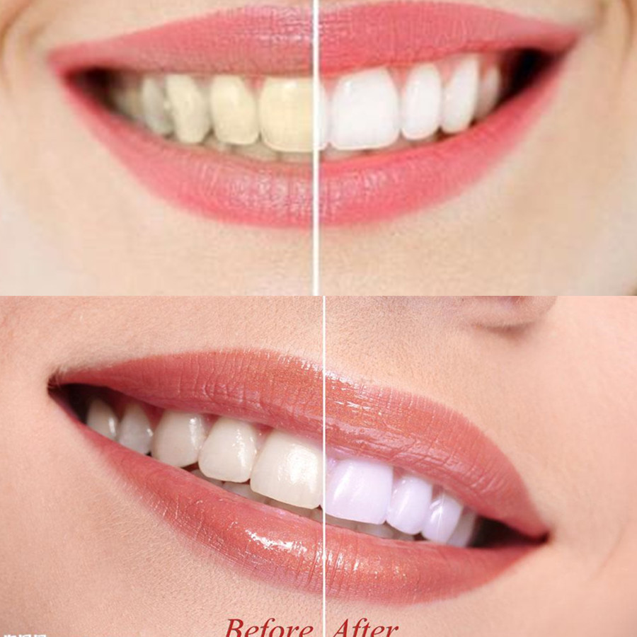 Bambus Holzkohle Zähne Zahn De – Teeth Whitening App Bewertung und Preis