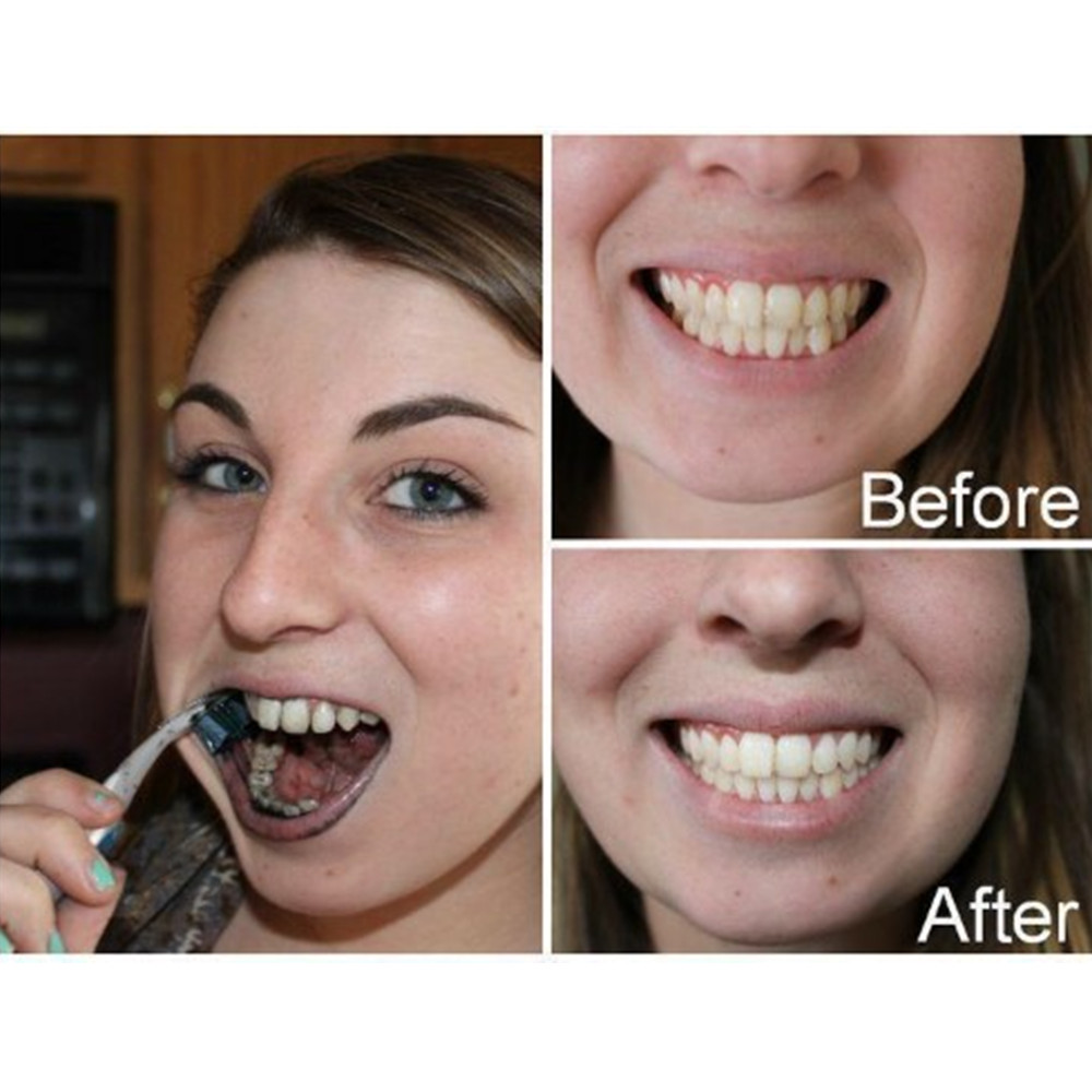 Bambus Holzkohle Zähne Zahn De – Teeth Whitening App Bewertung und Preis