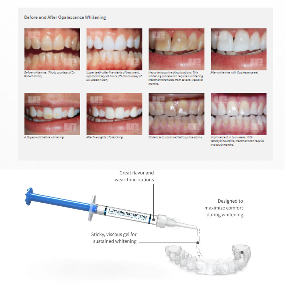 Opale scence White ning 1,2 pf – Teeth Whitening In Office Bewertung und Preis