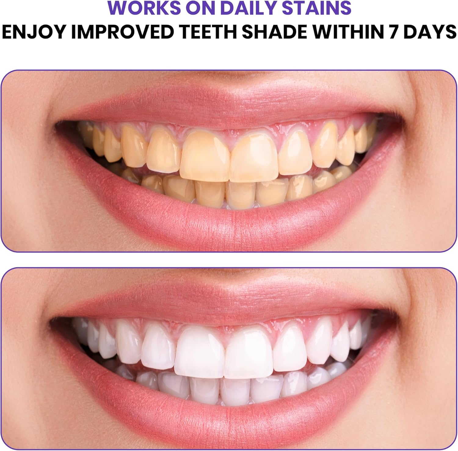 Fortschrittliche Lila Zahnaufh – Teeth Whitening In Office Bewertung und Preis