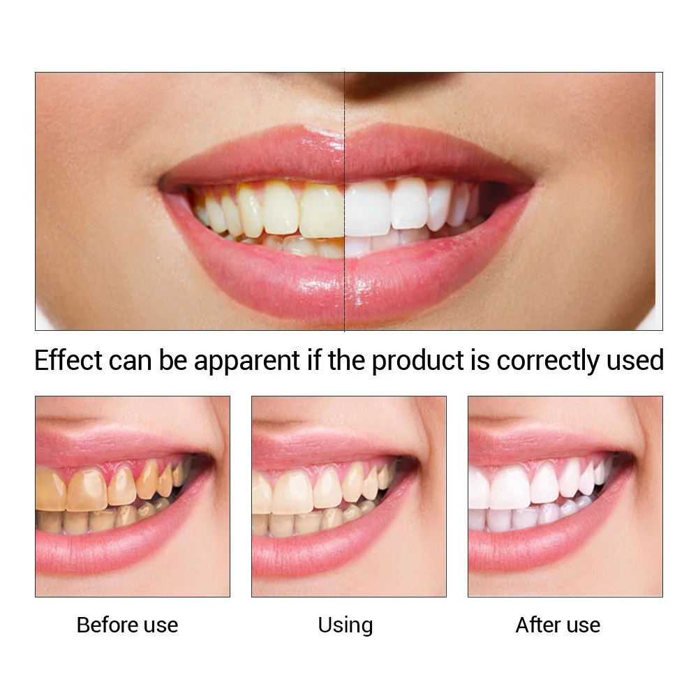 FTEENPLY Zahnaufhellung Essenz – Teeth Whitening App Bewertung und Preis