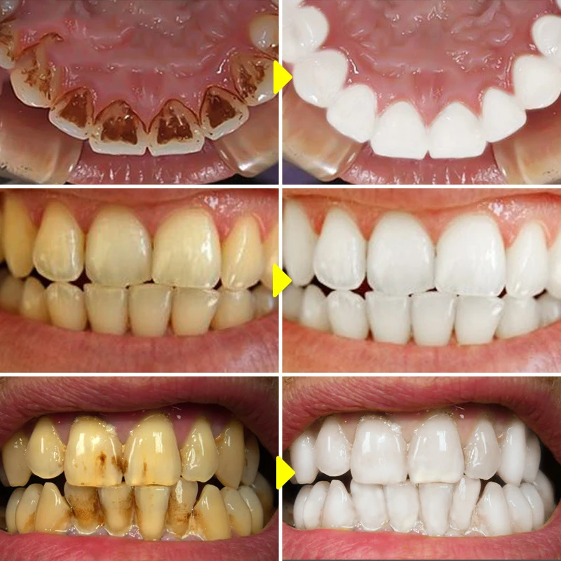 V34 Zahnaufhellung Mousse Zahn – Teeth Whitening Mousse Bewertung und Preis
