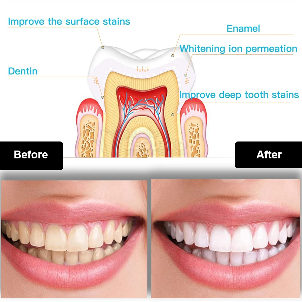Dental Zahnaufhellung Kit Mini – Teeth Whitening App Bewertung und Preis