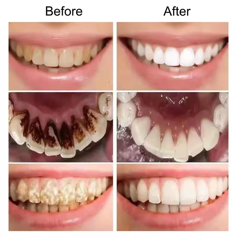 V34 Lila Zähne Bleaching Zahnp – Teeth Whitening Mousse Bewertung und Preis