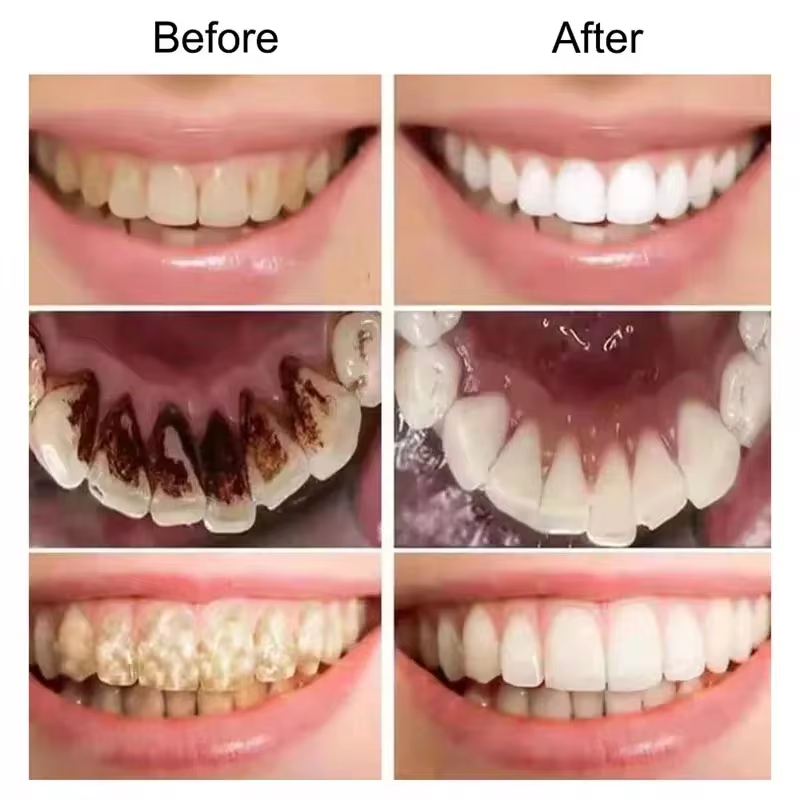 7,5% Hydroxyapatit Probiotisch – Teeth Whitening Best Bewertung und Preis