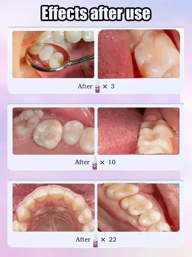 Zahnreinigung Zahnpasta Entfer – Teeth Whitening Best Bewertung und Preis